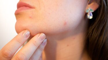 Doctor is seeing acne