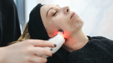 emoving facial spots by laser
